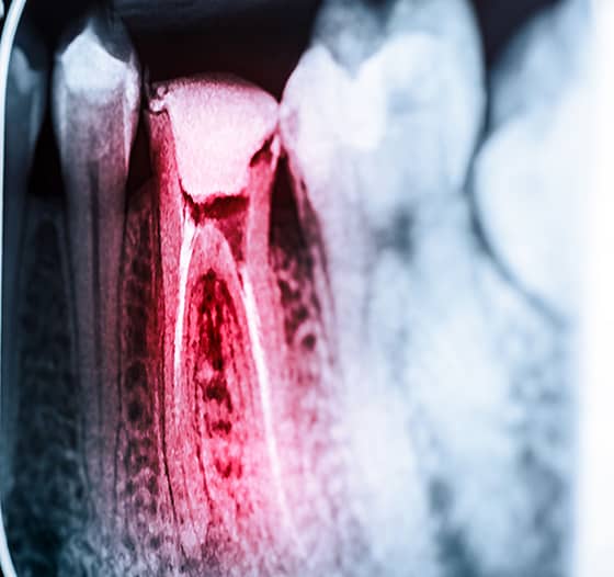 Root Canal Treatment Orpington