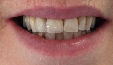 After - Smilemakerdentalcare
