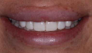 After - Smilemakerdentalcare