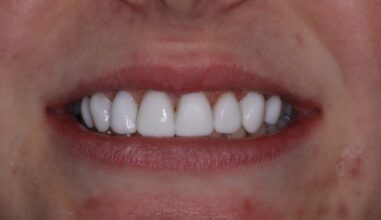 After - Smilemakerdentalcare