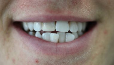 After - Smilemakerdentalcare