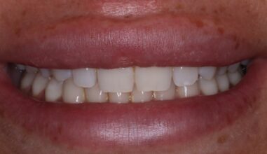 Before - Smilemakerdentalcare