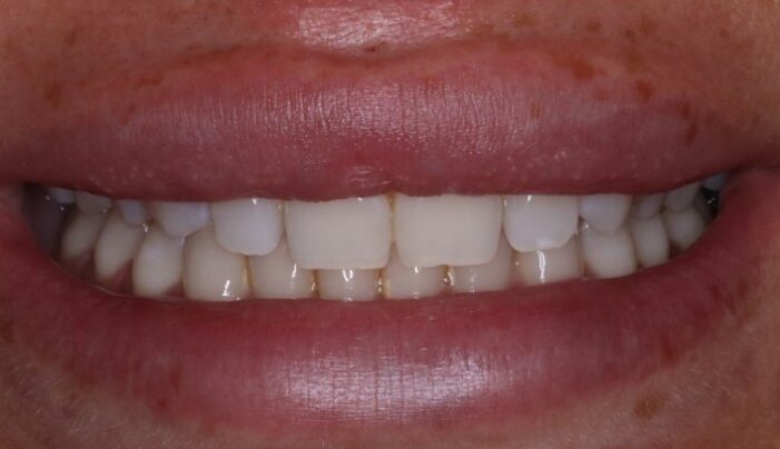 Before - Smilemakerdentalcare