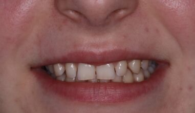 Before - Smilemakerdentalcare