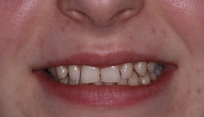 Before - Smilemakerdentalcare