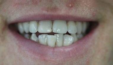 Before - Smilemakerdentalcare