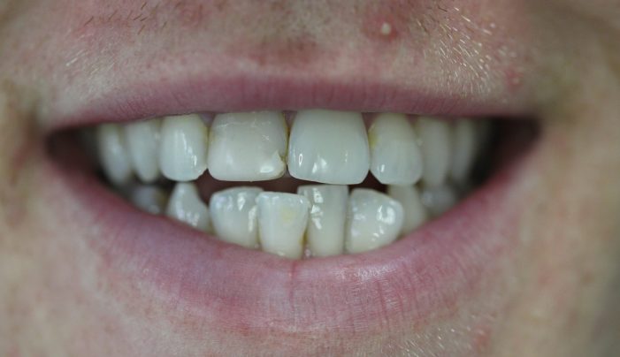 Before - Smilemakerdentalcare