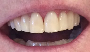 After - Smilemakerdentalcare