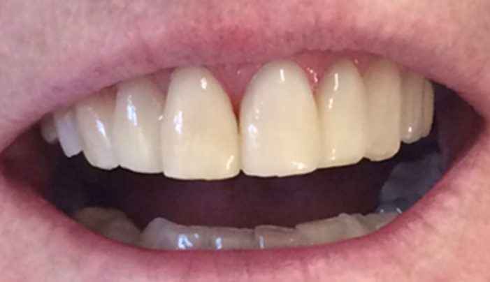 After - Smilemakerdentalcare