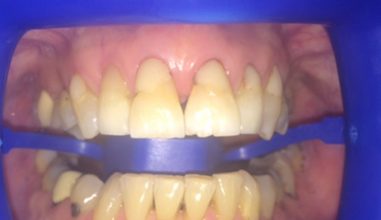 Before - Smilemakerdentalcare