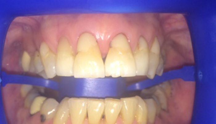 Before - Smilemakerdentalcare