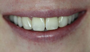 After - Smilemakerdentalcare