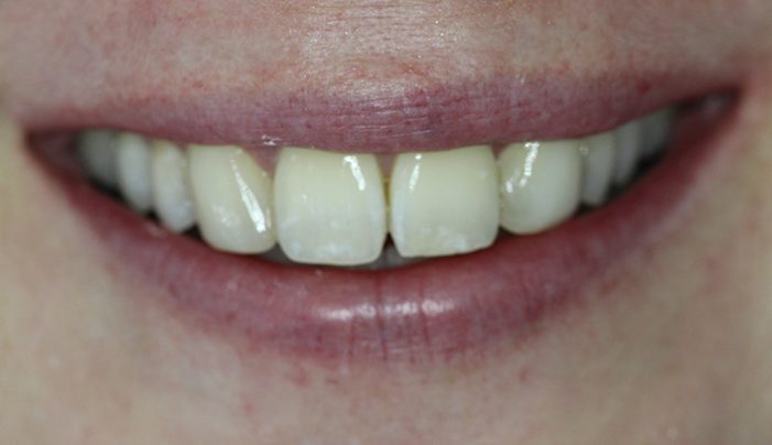 After - Smilemakerdentalcare
