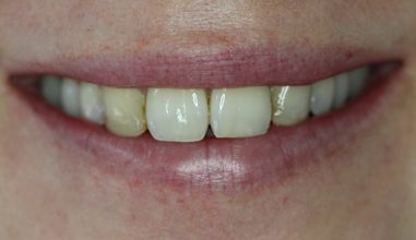 Before - Smilemakerdentalcare