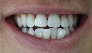 After - Smilemakerdentalcare