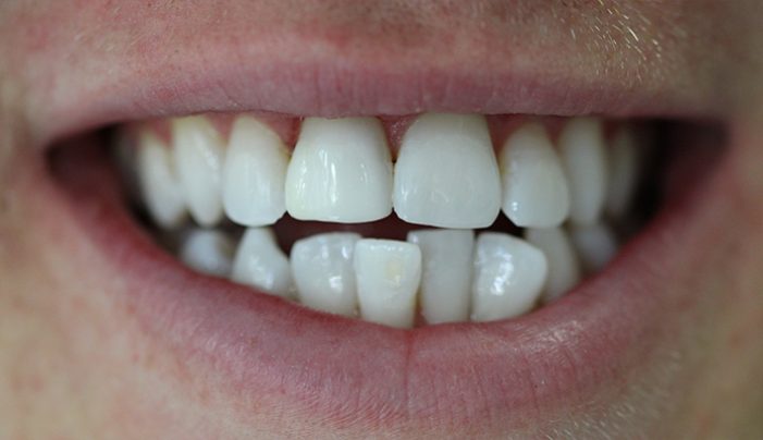 After - Smilemakerdentalcare