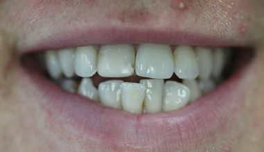 Before - Smilemakerdentalcare