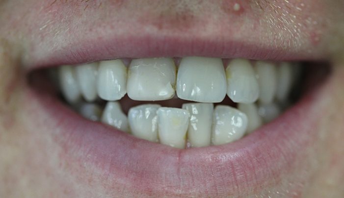 Before - Smilemakerdentalcare