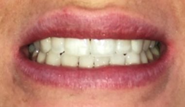 After - Smilemakerdentalcare