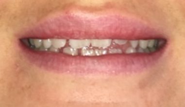Before - Smilemakerdentalcare