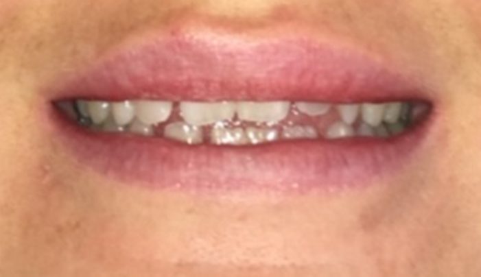 Before - Smilemakerdentalcare