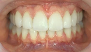 After - Smilemakerdentalcare