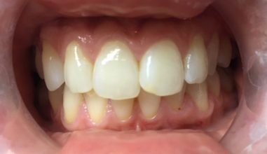 Before - Smilemakerdentalcare