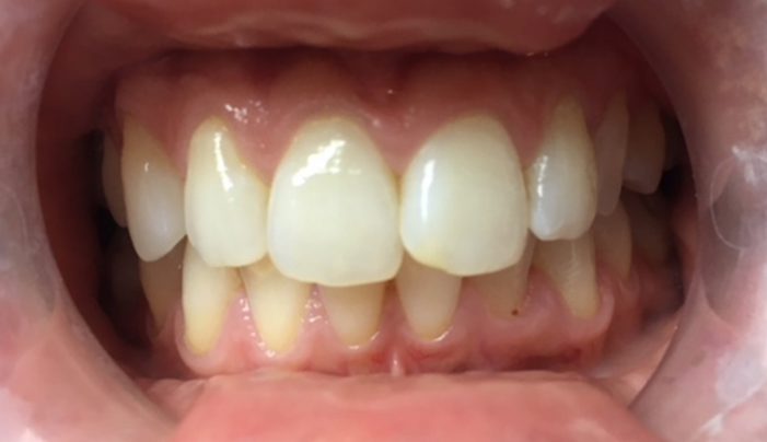 Before - Smilemakerdentalcare