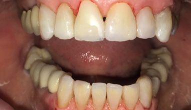 After - Smilemakerdentalcare