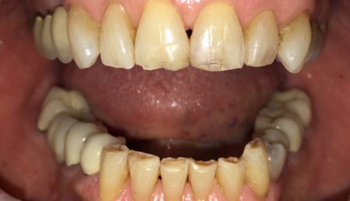 Before - Smilemakerdentalcare