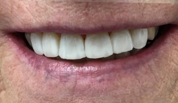 After - Smilemakerdentalcare
