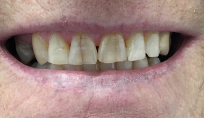 Before - Smilemakerdentalcare