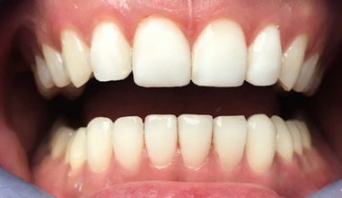 After - Smilemakerdentalcare