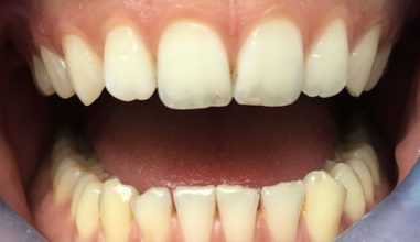 Before - Smilemakerdentalcare