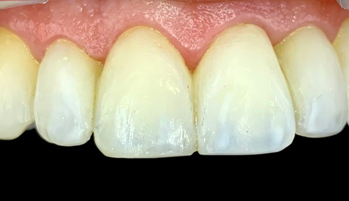 After - Smilemakerdentalcare