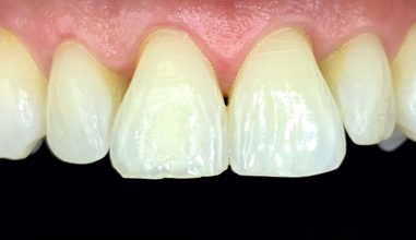 Before - Smilemakerdentalcare