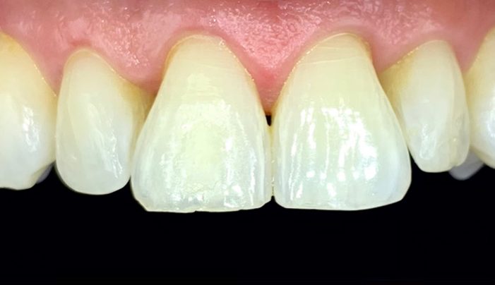Before - Smilemakerdentalcare