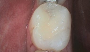 After - Smilemakerdentalcare