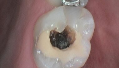Before - Smilemakerdentalcare