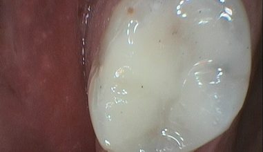 After - Smilemakerdentalcare