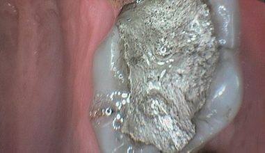 Before - Smilemakerdentalcare