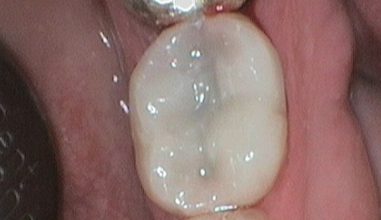 After - Smilemakerdentalcare