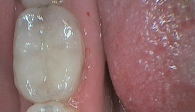 After - Smilemakerdentalcare