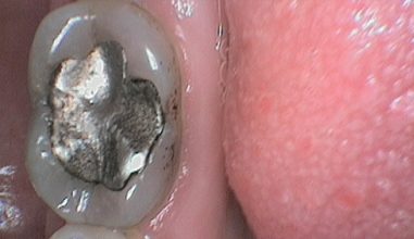 Before - Smilemakerdentalcare