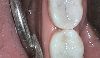 After - Smilemakerdentalcare