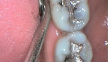 Before - Smilemakerdentalcare