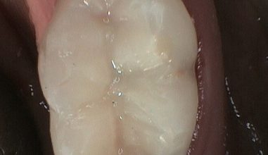 After - Smilemakerdentalcare