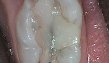 Before - Smilemakerdentalcare
