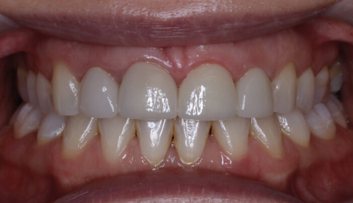 After - Smilemakerdentalcare