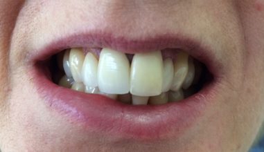 Before - Smilemakerdentalcare